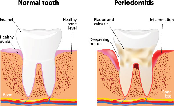 The image is a medical illustration showing the process of periodontitis from normal tooth health to advanced stages with bone loss and gum pocket formation.