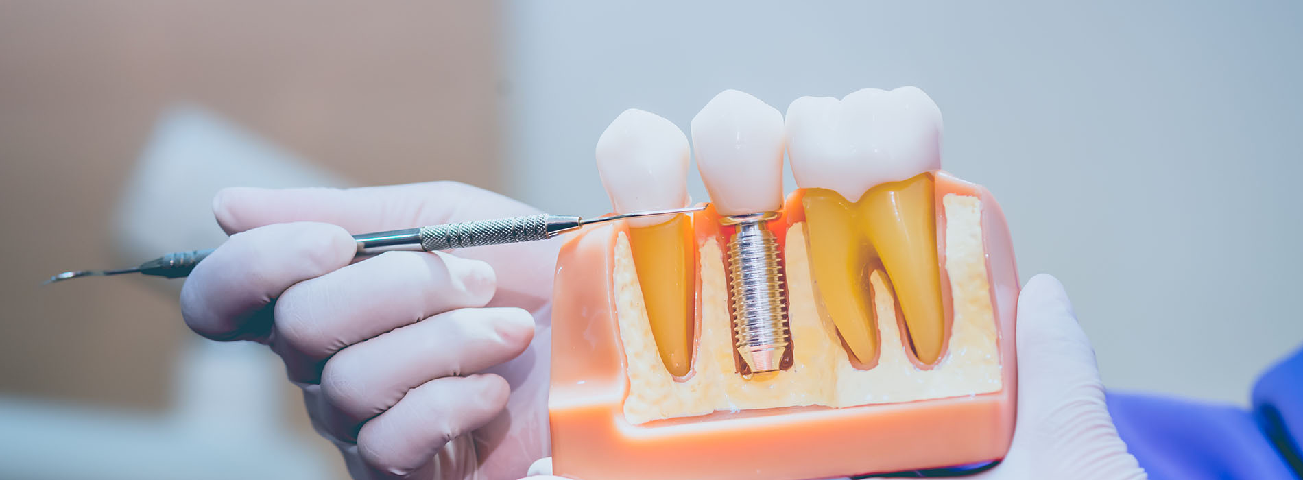 An image of a person holding a dental implant tool, with a focus on the precision screw and the plastic casing.